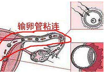 盆腔粘连如何做试管婴儿成功率高