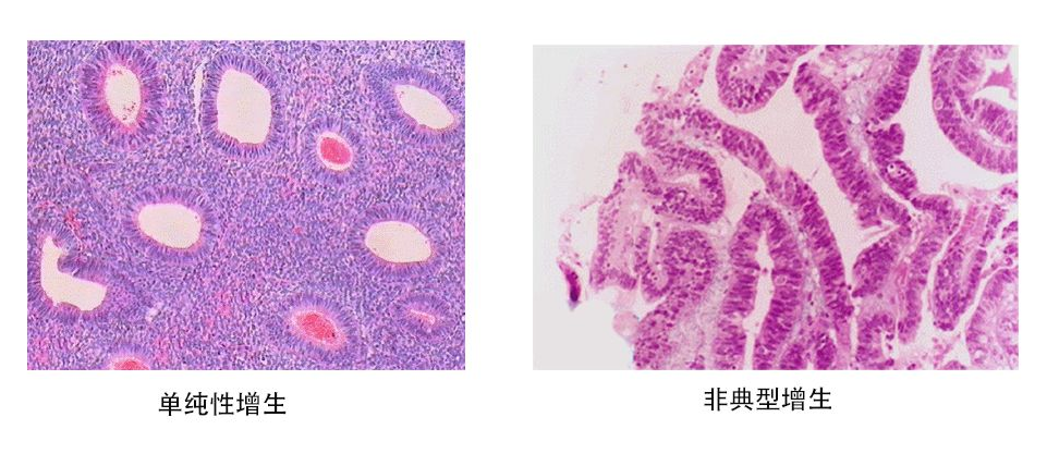 女性子宫内膜增生适合到做上海试管婴儿吗