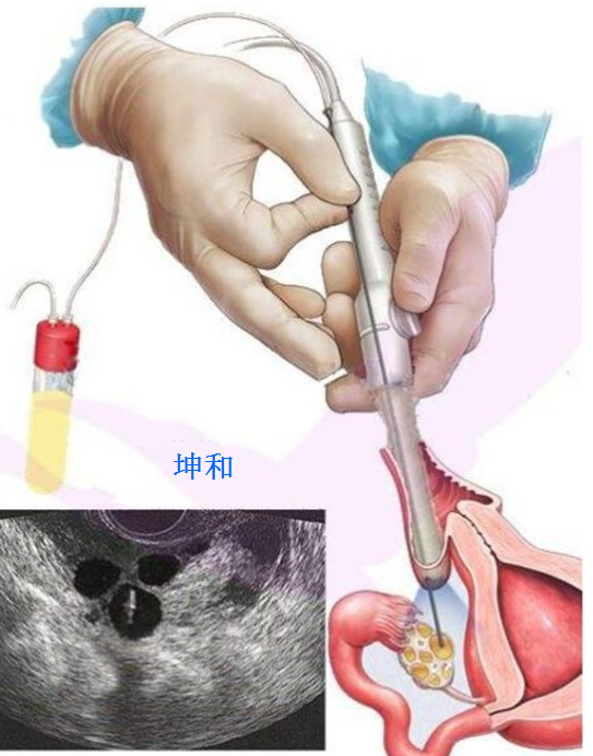 卵泡发育不良原因有哪些？做上海试管婴儿应该注意哪些呢？