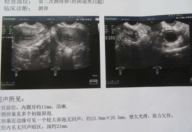 坤和上海代怀孕中心如何通过促排获取优质卵子