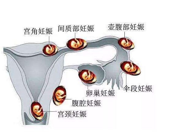 宫外孕与试管助孕有什么关系？坤和试管较有选择价值