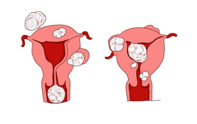 哪种情况的子宫肌瘤需要处理后才能做试管婴儿