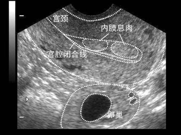 子宫内膜息肉为何会影响不孕？如何通过试管婴儿提高受孕率？