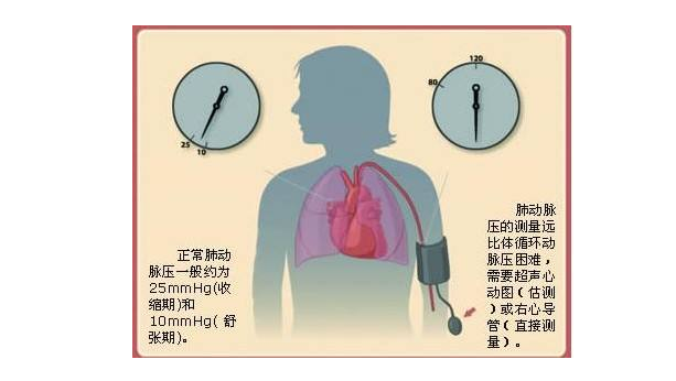 肺动脉高压女性如何生个自已的孩子 可以通过代怀孕吗