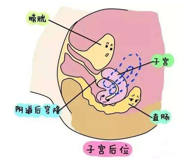 子宫后位对上海试管婴儿胚胎移植有影响吗？