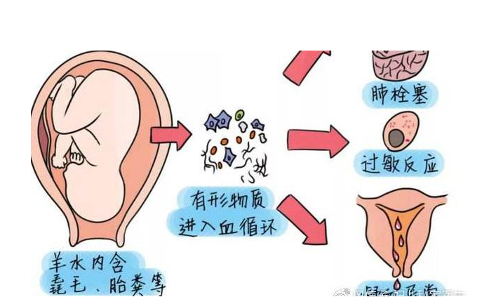 哪些人容易得羊水栓塞  做试管婴儿可以避免吗