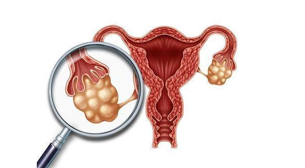 卵巢囊肿可以怀孕吗？能做试管婴儿吗？