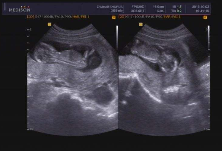 上海试管婴儿生双胎的概率与风险剖析